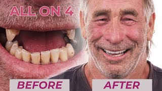 Mark's Dental Implants Before & After Transformation | Dental Boutique screenshot 3