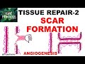 TISSUR REPAIR Part 2: Repair by SCAR formation.  ANGIOGENESIS, GRANULATION TISSUE, TISSUE REMODELING