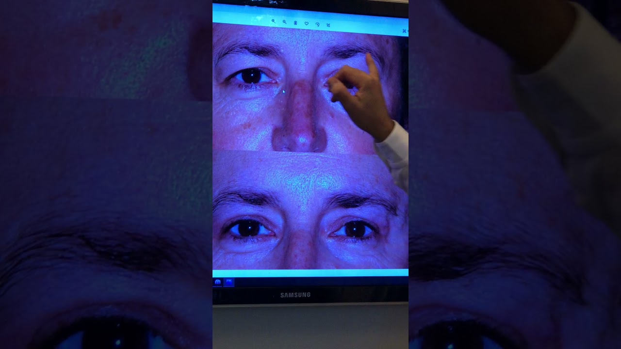 CHIRURGIE DE LA PAUPIERE SUPERIEURE : BLEPHAROPLASTIE SUPERIEURE