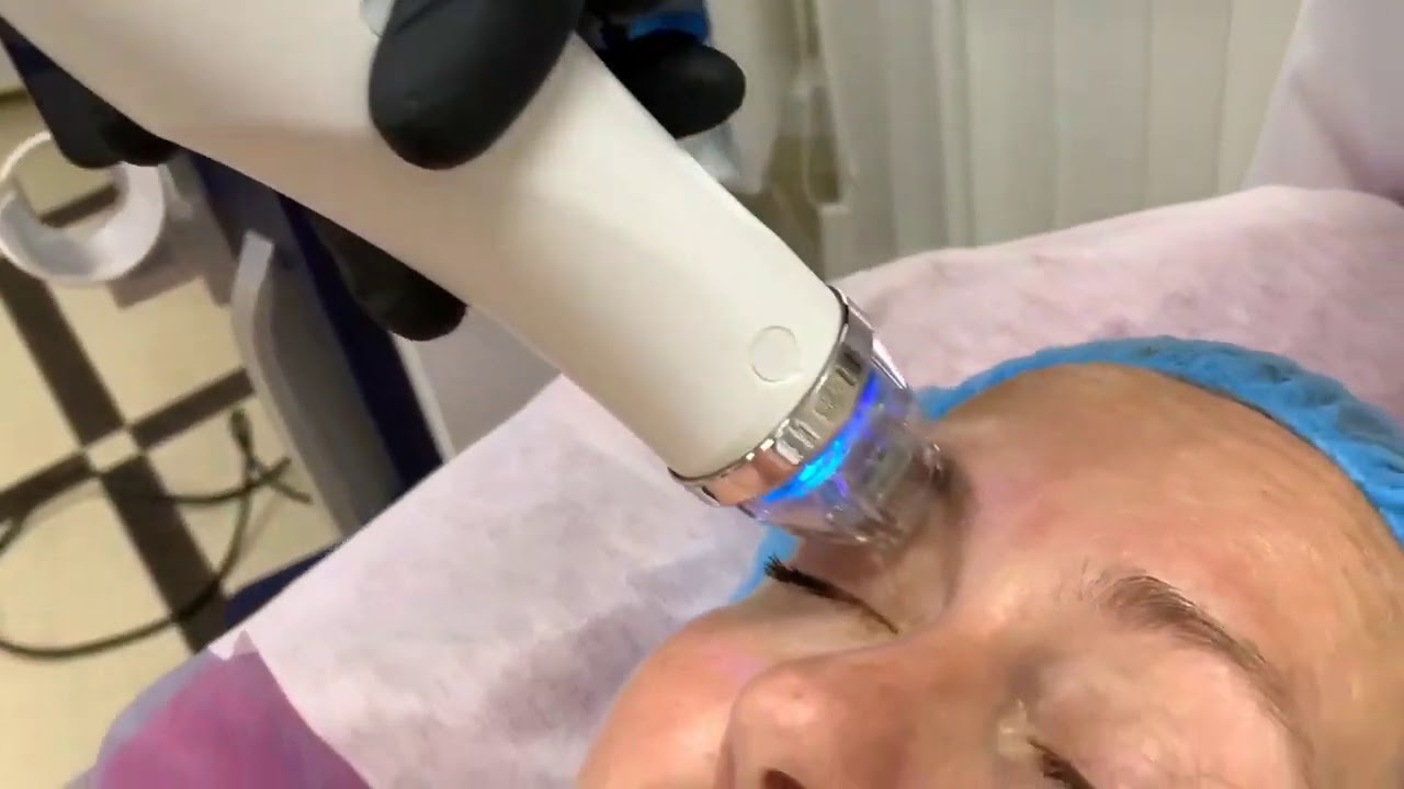 «Омоложение лица на аппарате "Secret RF”