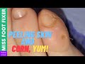 Peeling Skin and Corn, Yum! | Miss Foot Fixer |  Marion Yau