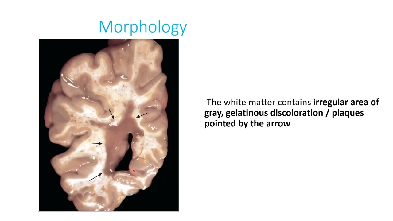 Demyelinating and Degenerative diseases of CNS part 1