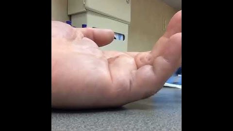 Dupuytrens Xiaflex Cord Breaks