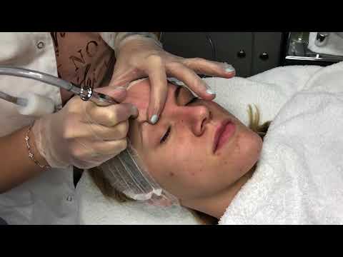 SKIN CARE| Mikrodermoabrazija- tretman lica