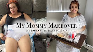 My Mommy Makeover - 10 Days Post Op