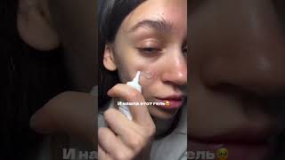 Гель для акне