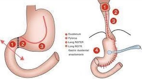 Esophagoplasty CPT code - simplify medical coding