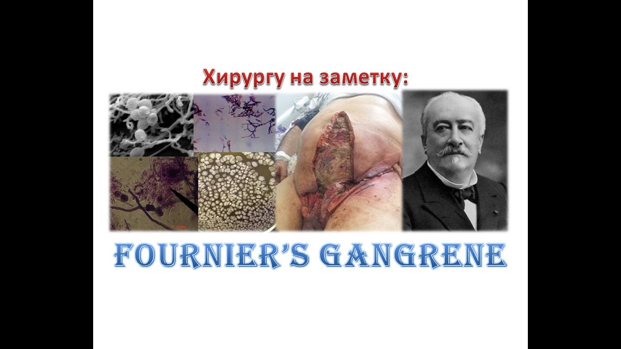 Гангрена Фурнье (Fournier's gangrene). Хирургу на заметку.