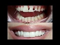 Teeth Decay Smile Makeover Beirut Lebanon علاج تسوس الاسنان Teeth Decay Smile Makeover Beirut Lebanon علاج تسوس الاسنان