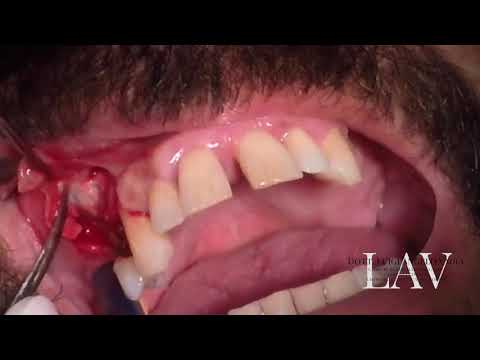 Video: Cisti Del Dente (alla Radice): Cause E Sintomi, Rimozione Della Cisti Alla Radice Del Dente (intervento Chirurgico)