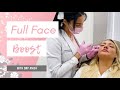 FULL FACE BOOST By DNP Anisa (Watch entire journey of Botox + Lip, Cheek, & Smile Line Fillers)