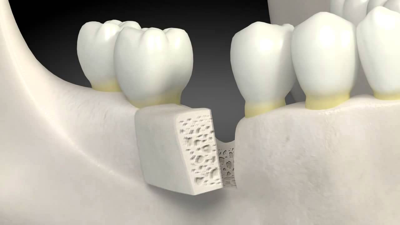 Dental Bone Graft Procedure Vancouver WA What is a dental bone graft