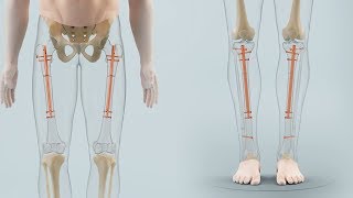 BETZBONE® - Cosmetic limb lengthening made in Germany