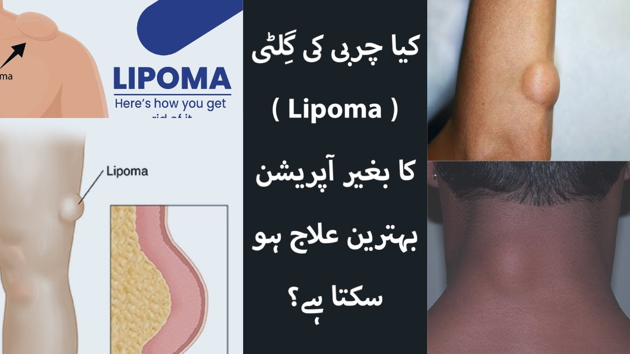 Best treatment for lipoma | lipoma ka behtreen ilaj - YouTube