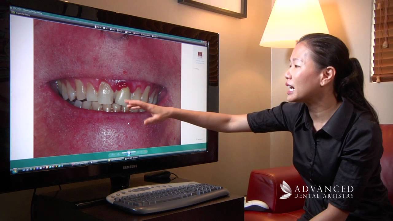 Advanced Dental Artistry - Fixing a recurring problem - Perth Cosmetic and Dental Implant Team