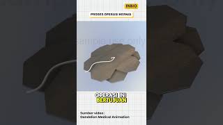Proses operasi hernia abdomen