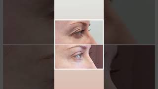 Спустя 2 недели после верхней блефаропластики 👁️  (операции верхних век). Как вам результат? 🔥?