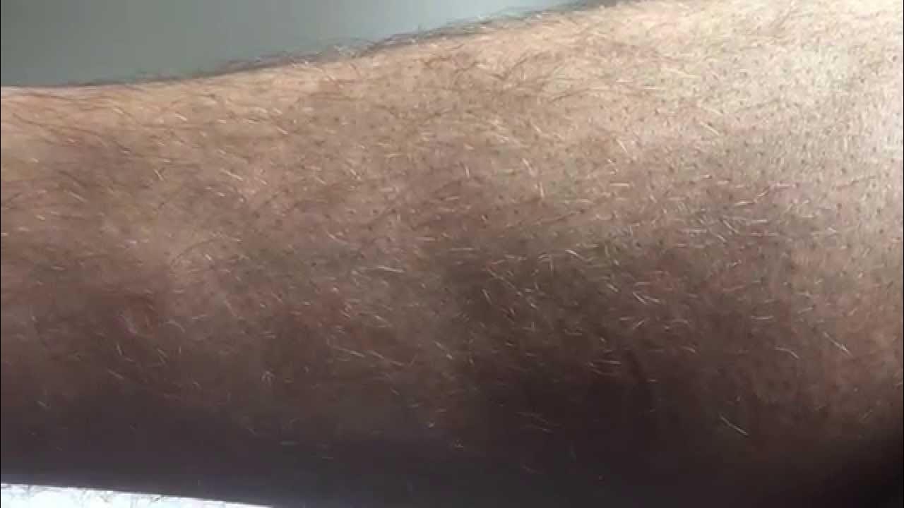 Benign Fasciculation Syndrome (Calf Fasciculation) BFS leg muscles twitching YouTube