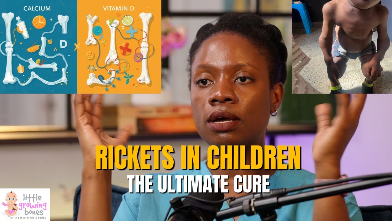 Mervin Rickets Rickets In Children Cure