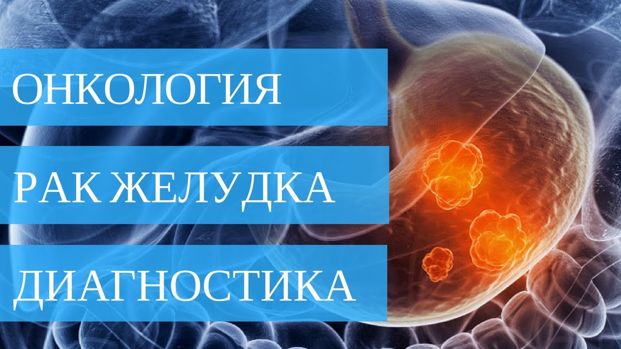 РАК ЖЕЛУДКА - диагностика на ранних и поздних стадиях - YouTube