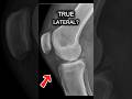 Don't Lose Marks - Is This a Good Lateral Knee X-ray? #1