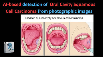AI based detection of  Oral Cavity Squamous Cell Carcinoma from photographic images