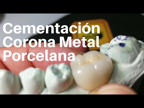 CORONA DENTAL👅Metal Porcelana #coronadental