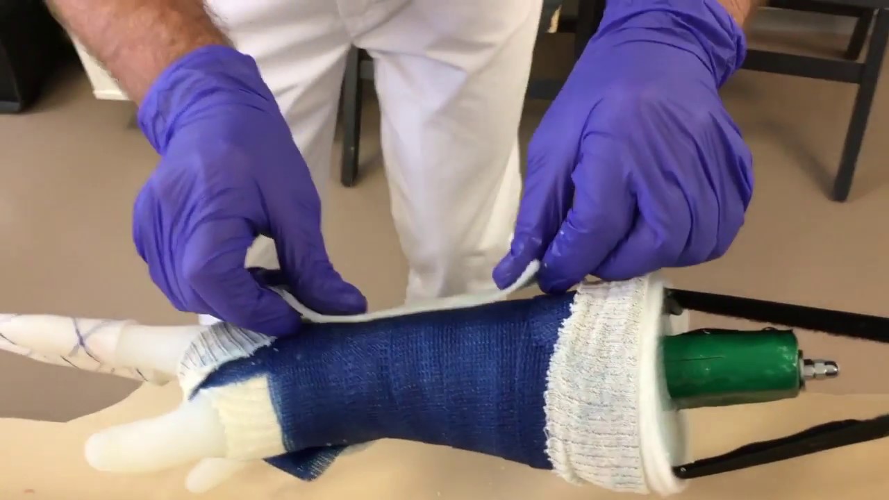 Repositie Colles Fractuur met 2X Driepuntsdruk met Combicast