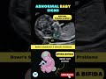 Abnormal Baby signs 👨&zwj;⚕️🧬 Down's Syndrome &amp; Genetic Problems #shortsfeed #baby #genetics #pregnancy