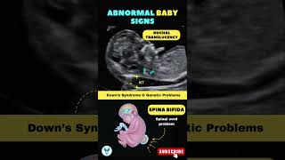 Abnormal Baby signs ?‍⚕️? Downs Syndrome & Genetic Problems shortsfeed baby genetics pregnancy