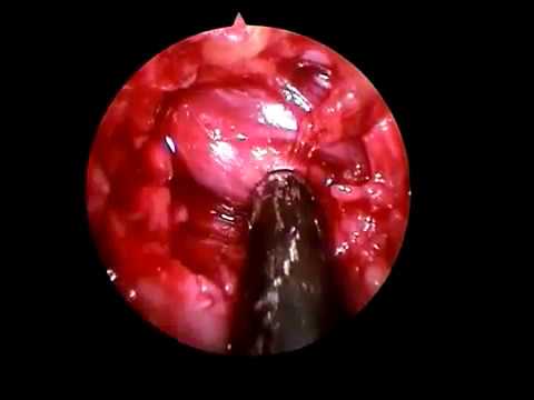 Extracción Hernia Discal