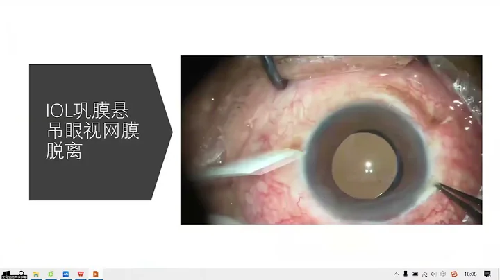 手术讲解：一组特殊类型的视网膜脱离手术 - 天天要闻
