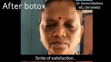 Botox injection for blepharospasm before and after।। Dr. Govind Madhaw