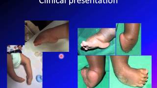 clubfoot / talipes equinovarus / TEV