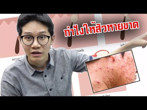 ถ้าไม่อยากให้มีสิวขึ้นต้องทำอย่างไร?