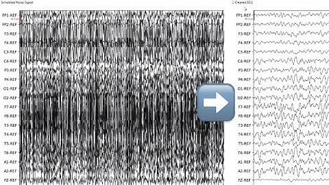 AiON EEG Artifact Reduction vs HFF