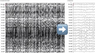 AiON EEG Artifact Reduction vs HFF