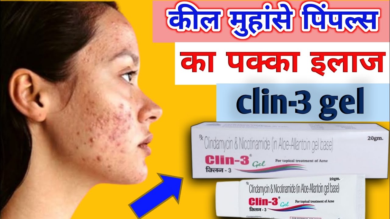 Clin 3 Gel Review | Pimples हटाने की Best Gel सही तरीका Side Effects &  | क्लिन 3 जेल पूरा रिव्यू