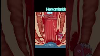 HEMORRHOIDS - MEDICAL DEFINITION | Medical Consecutive Interpreting