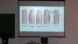 Lecture On Aneurysms vs. Vasodilation &amp; Types of Heart Failure | Pathology | MBBS