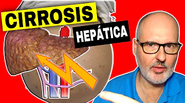 ¿Es la cirrosis hepática un asesino silencioso?