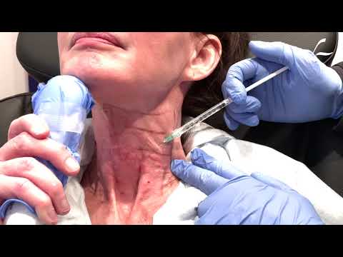 Dallas MesoBotox/Mesotox for the Neck by Dr. Lam