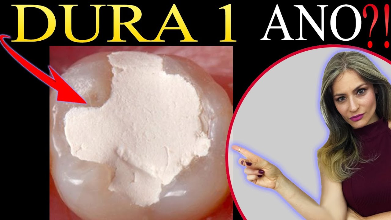 Massinha Curativo no dente quanto tempo dura, quanto tempo dura a ...