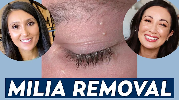 How Do You Remove Milia? A Dermatologist Shares Milia Treatment & Prevention Tips | DERM CHAT