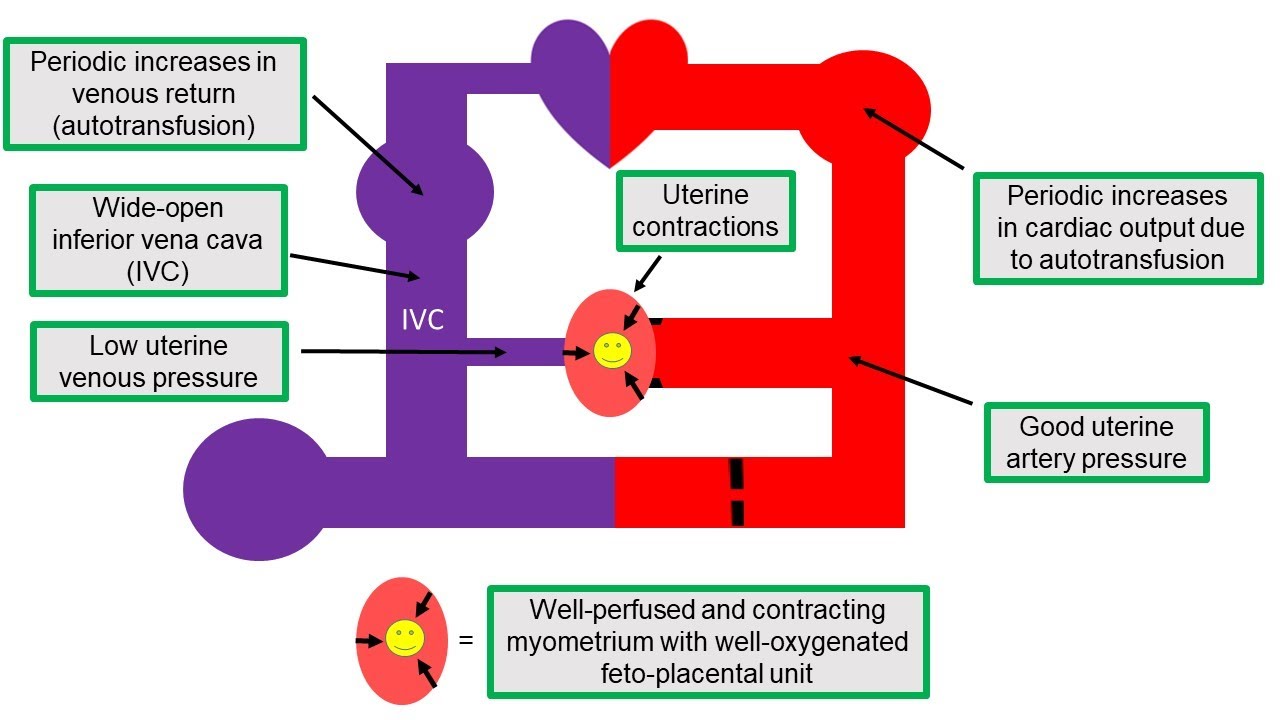Obstructed uterine venous return: a preventable cause of dysfunctional labor?