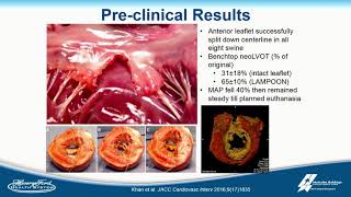Novel Mitral Leaflet Repair for TMVR - Adam Greenbaum, MD