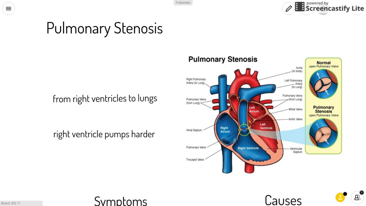 Pulmonary Stenosis Treatment