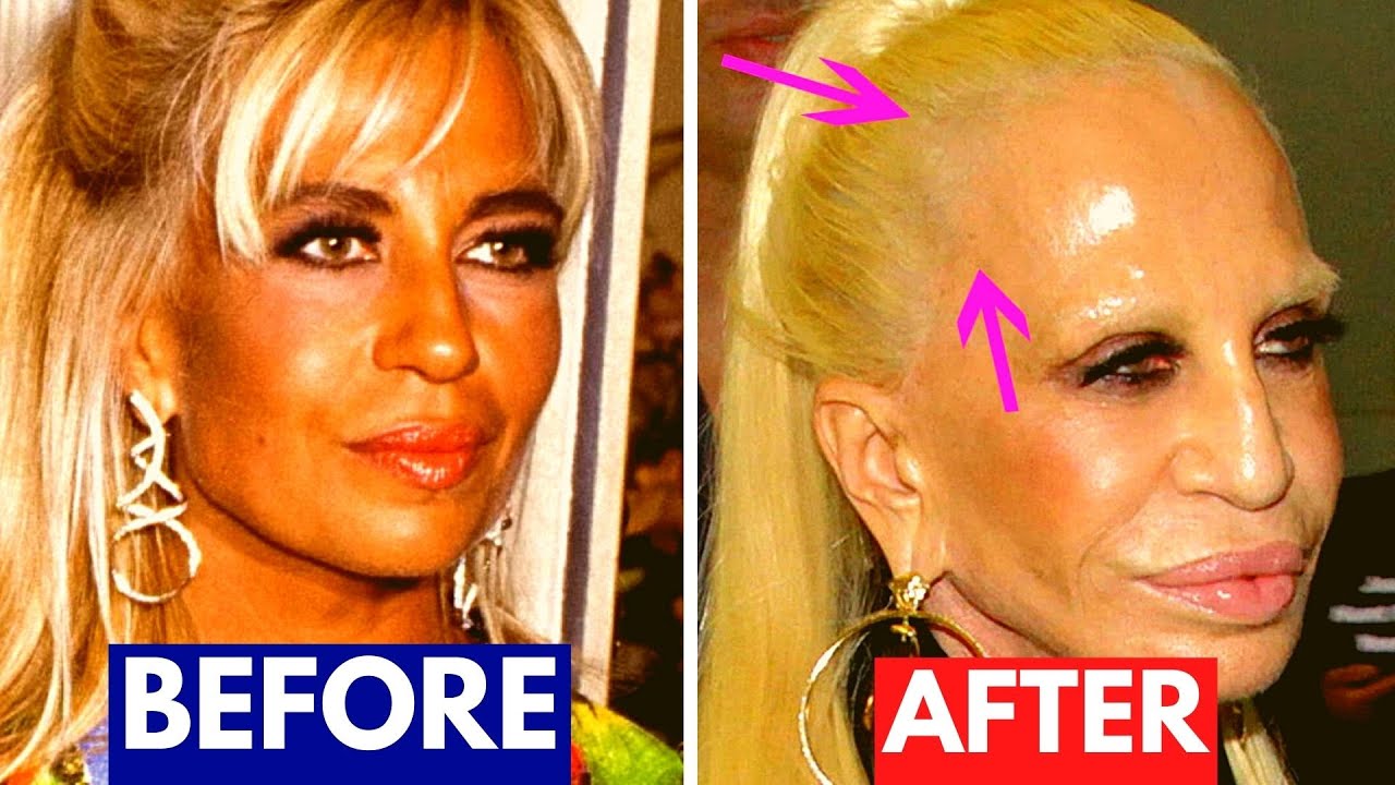 Botched Celebrity Plastic Surgery [before And Afters] Youtube