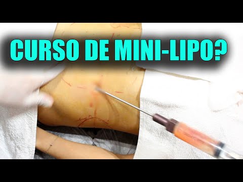 Vídeo: Liposucción No Quirúrgica