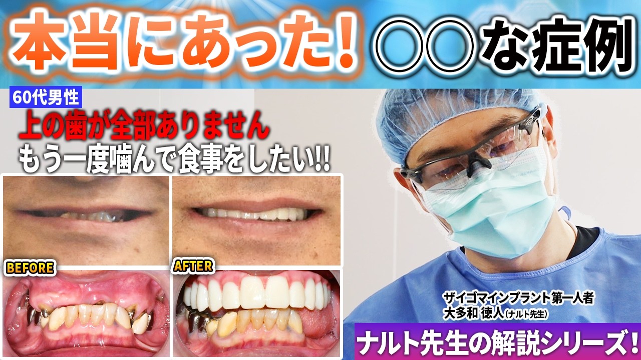 もう半年以上も噛んで食事をしていない60代男性をナルト先生がオールオン4で1日で噛めるようにした！本当にあったシリーズ上顎だけのオールオン4